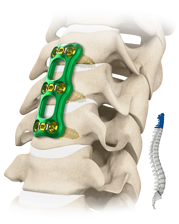 anterior-diskectomy